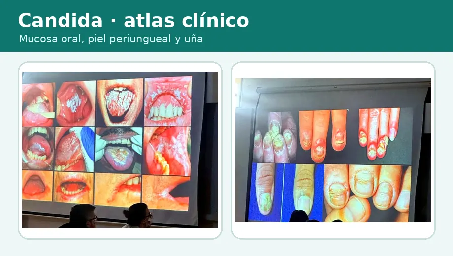 Miniatura del atlas clínico de candidiasis